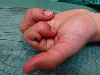 Intraoperative Fingerbeugung nach Sehnennaht